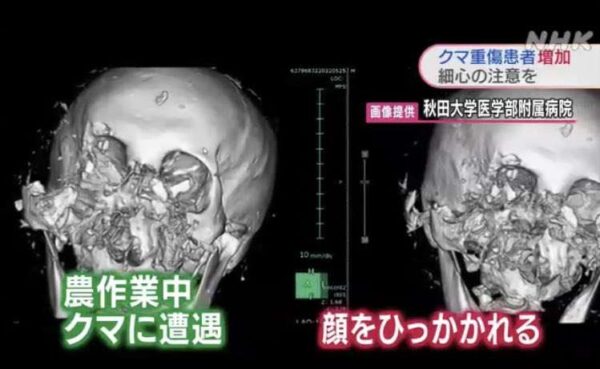 クマに襲われた人の3D CT画像